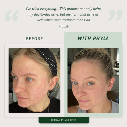 Acne-Fighting Phage System (60 Day Supply)