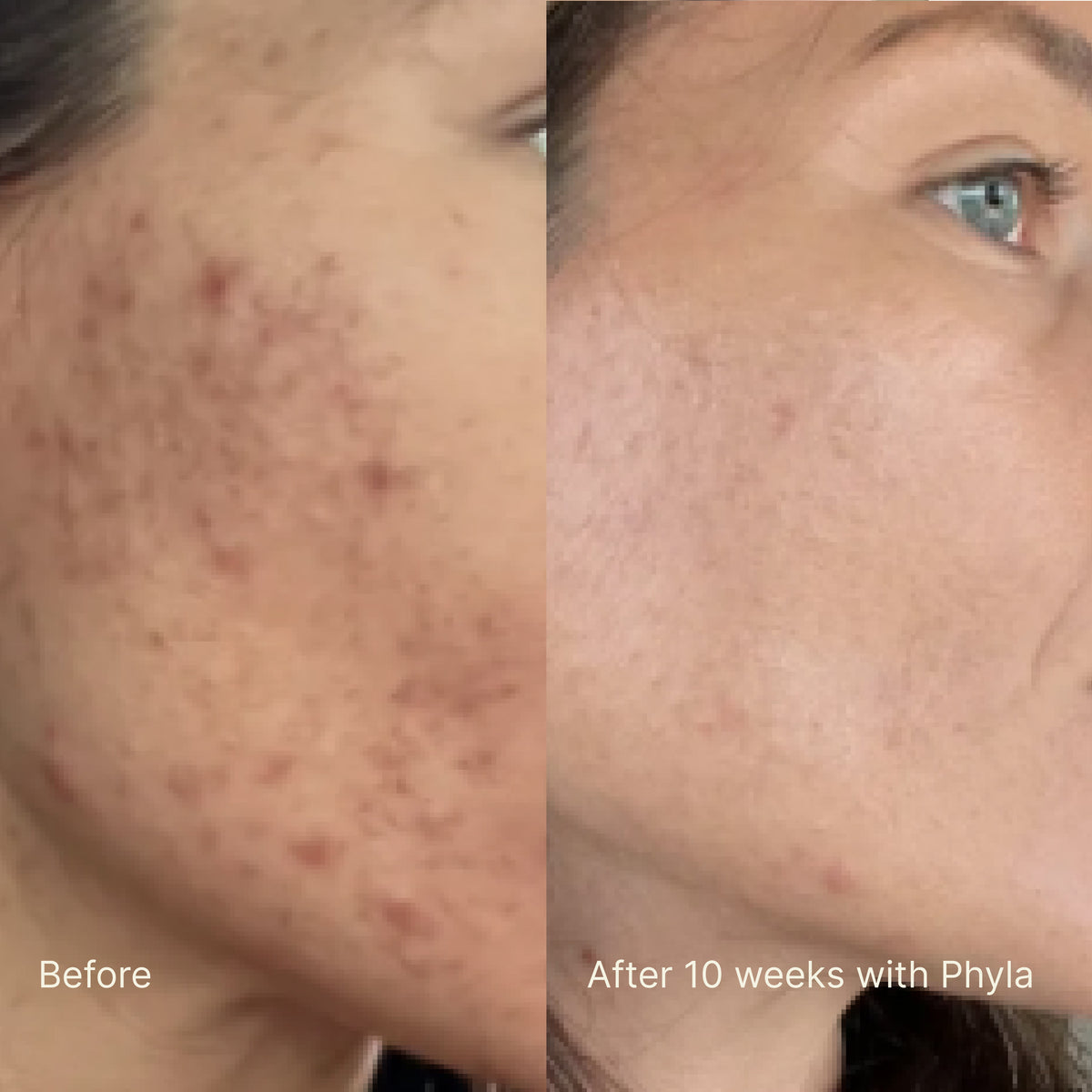 Acne Phage Serum