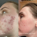 Acne Phage System thumbnail