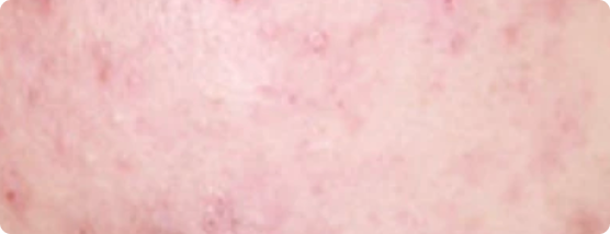 Teen Acne