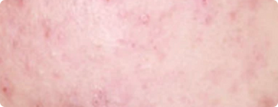 Teen Acne