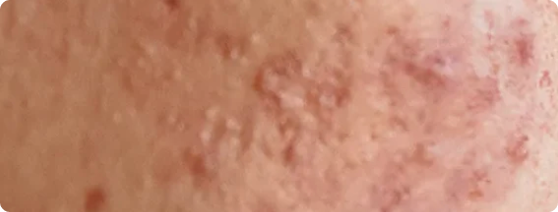 Hormonal Acne