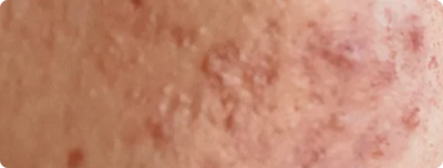 Hormonal Acne